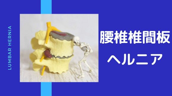 腰椎椎間板ヘルニア