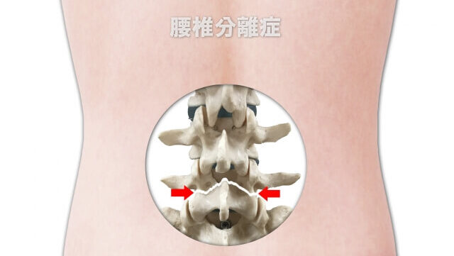 腰椎分離症の緩和方法